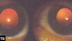 Figure 1b: No Weiss ring in either eye (postop)