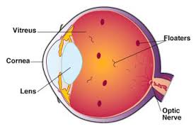 Diagram of eye floater