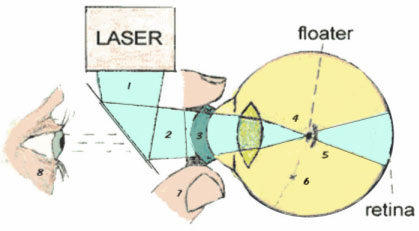 Diagram of retinal protection during laser treatment for eye floaters